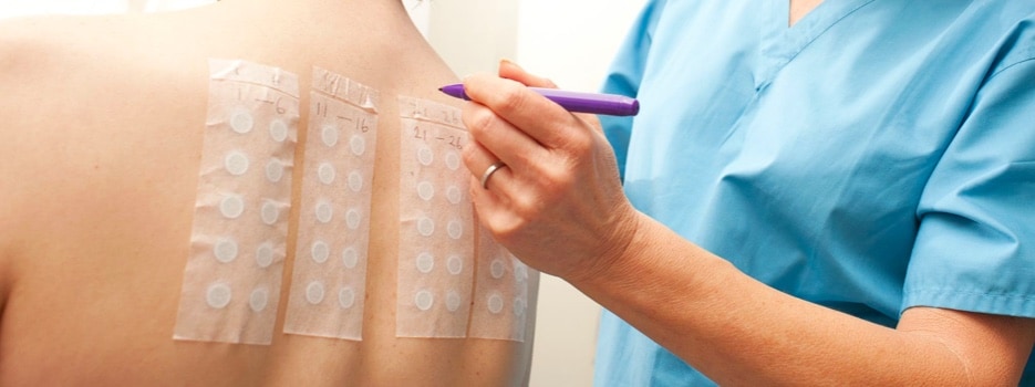 Kobieta z plastrami testu na alergię na plecach
